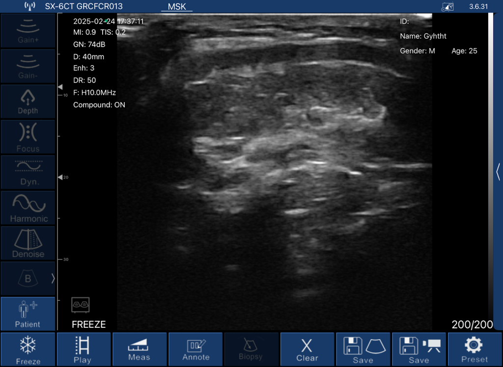 echografische beelden van de gewrichtsspleet van de knie en synoviale ruimte gemaakt met TodoPocus™ D3-Ultra