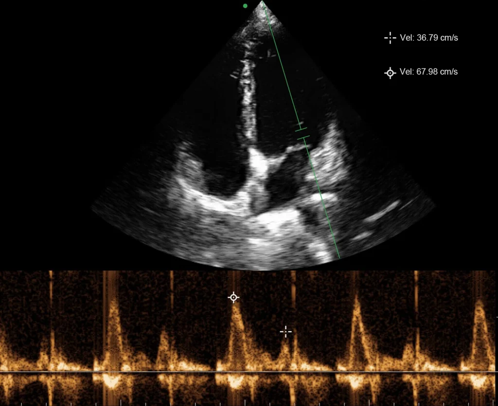 kardiyak PW Doppler mitral kapak giriş akım hızı