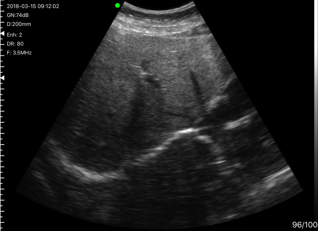 20 cm derinlikte derin abdominal karaciğer yağlanması değerlendirmesi