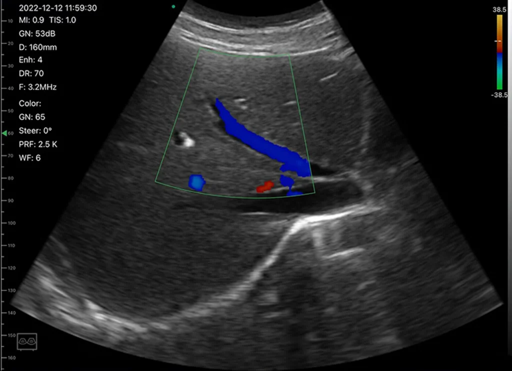karaciğer damarlarının Renkli Doppler ile değerlendirilmesi