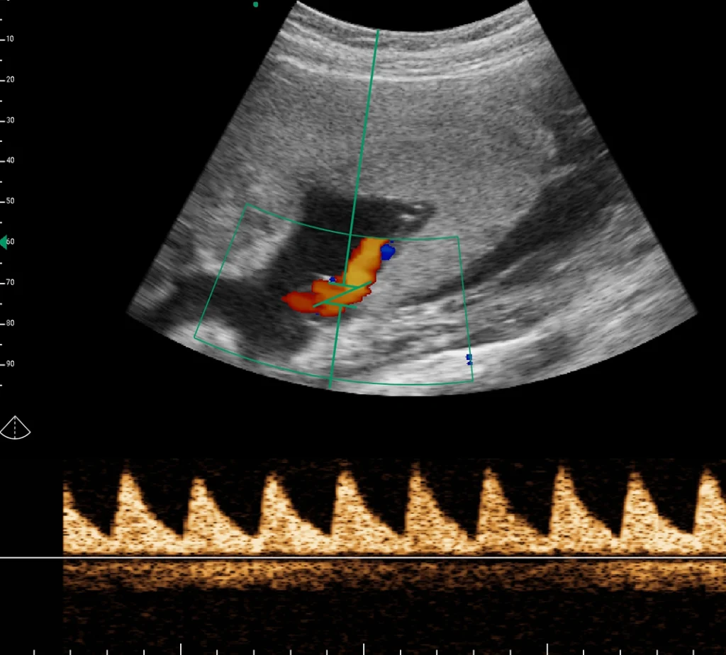 obstetride umbilikal arter ua Doppler spektrumu
