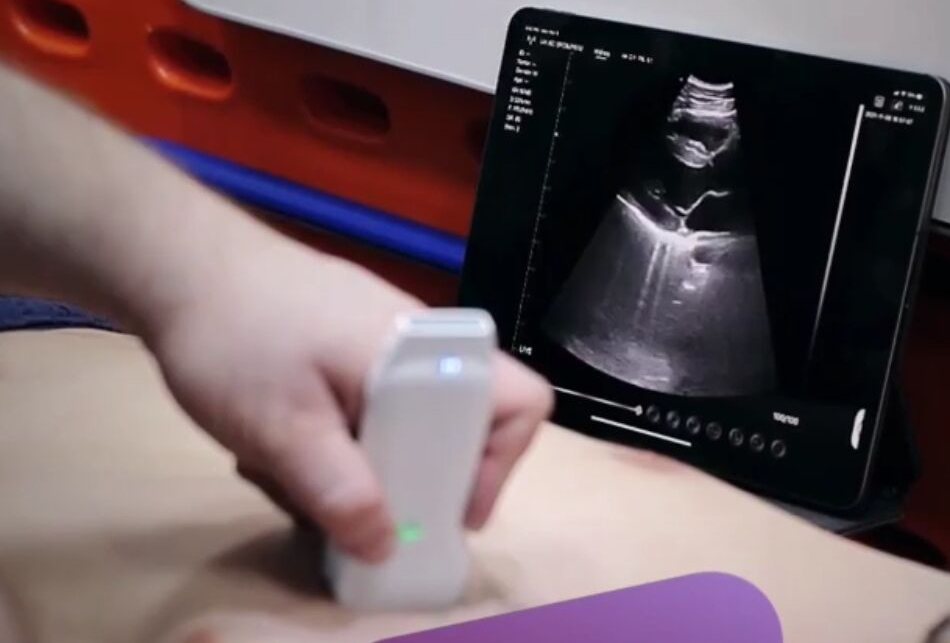 todopocus cd2 wireless cardiac ultrasound acquiring a parasternal long-axis plax echocardiogram view