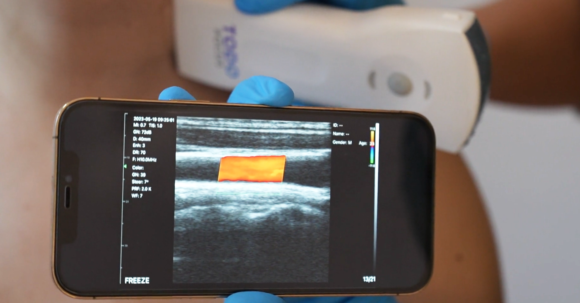 todopocus d3-ultra handheld ultrasound in use scanning the carotid artery, with the color doppler image shown on a smartphone