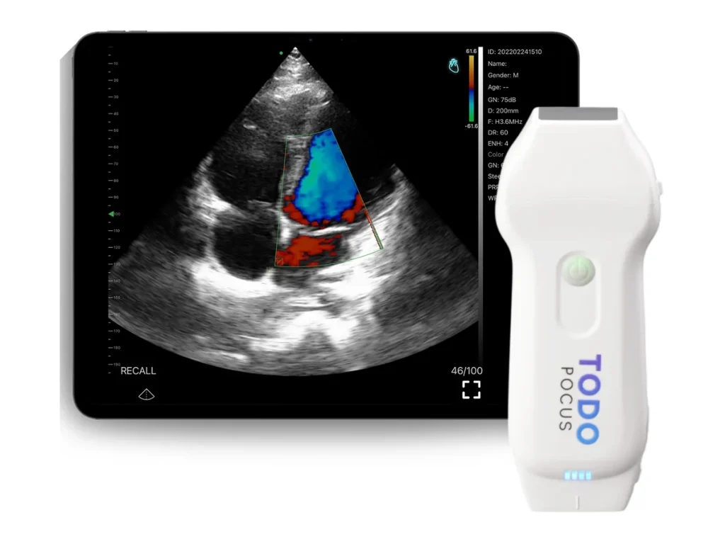 todopocus cd2 linear and phased array handheld ultrasound with cardiac color doppler on a tablet, mindray te air i3p alternative