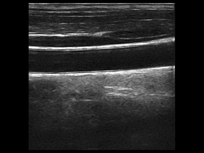 todopocus d3-ultra linear mode superficial b-mode imaging at 10 mhz