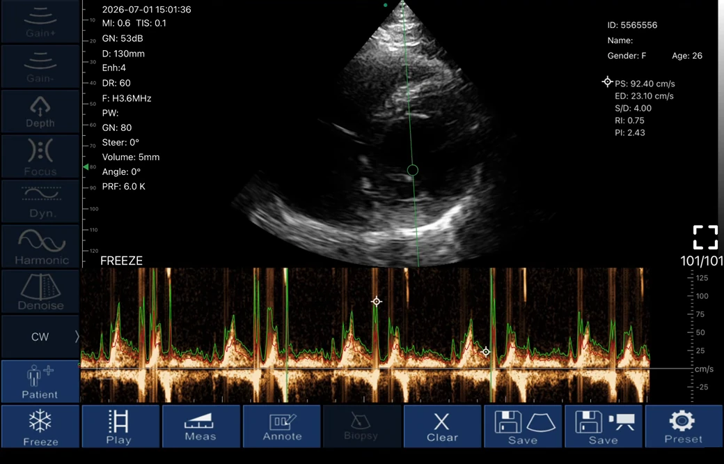 todopocus pd2 cw doppler cardiac spectral trace with peak and end-diastolic velocity measurements