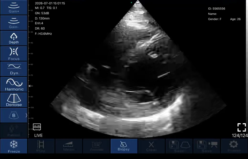 todopocus pd2 phased array parasternal cardiac view in b-mode at 3.6 mhz harmonic