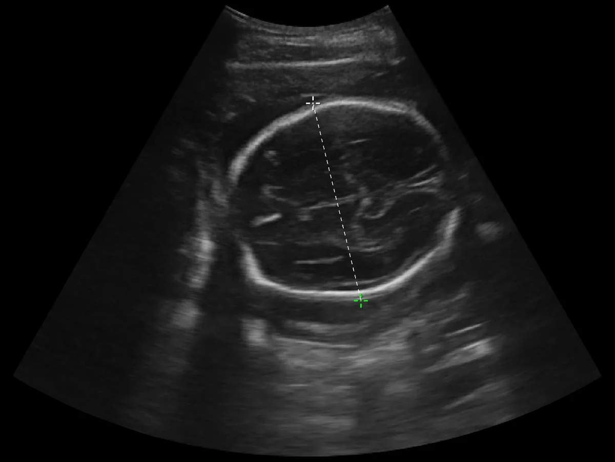todopocus c5s fetal head circumference measurement at 5 mhz