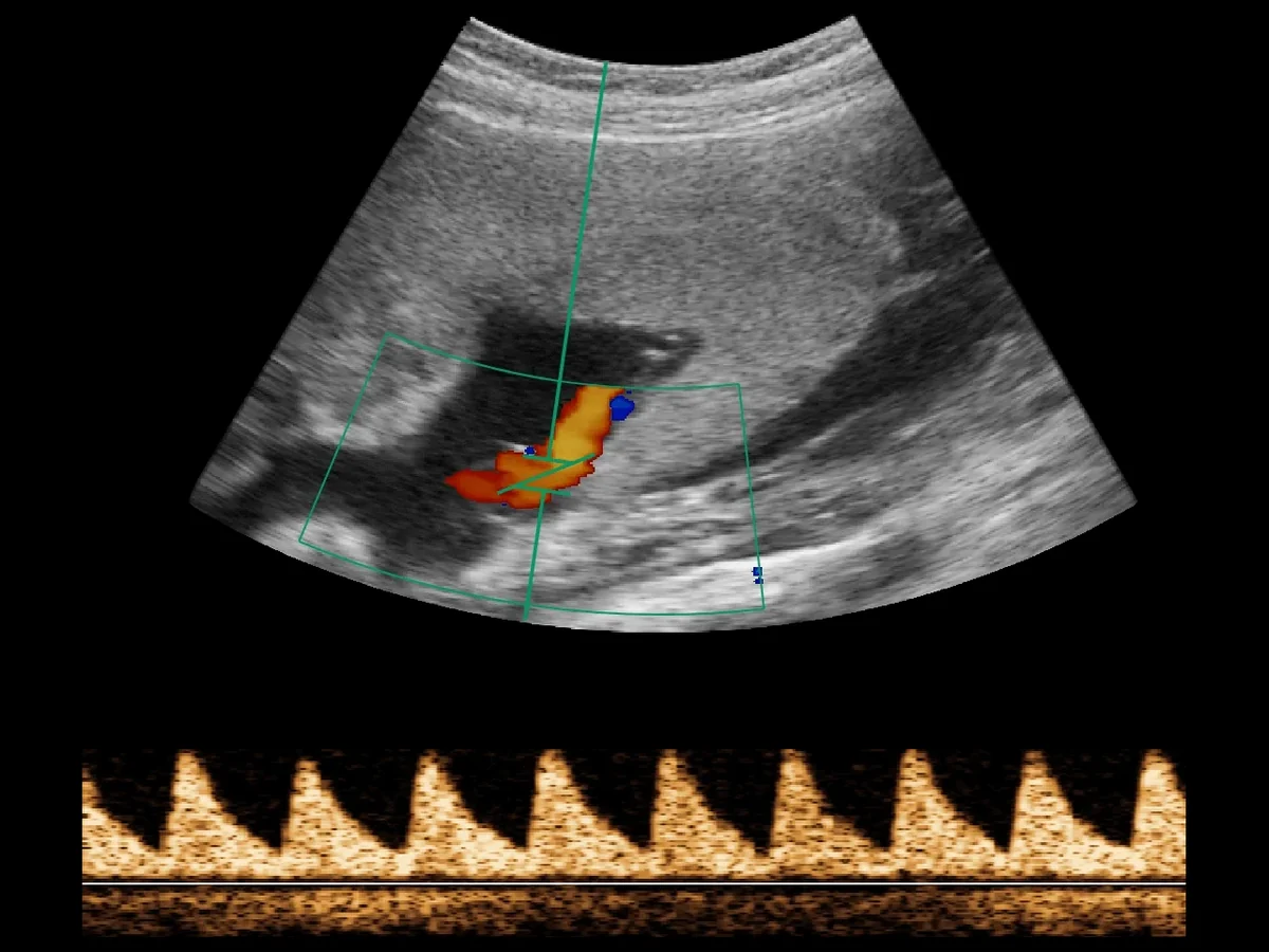 todopocus c5s pw doppler of fetal umbilical cord blood flow at 3.5 mhz