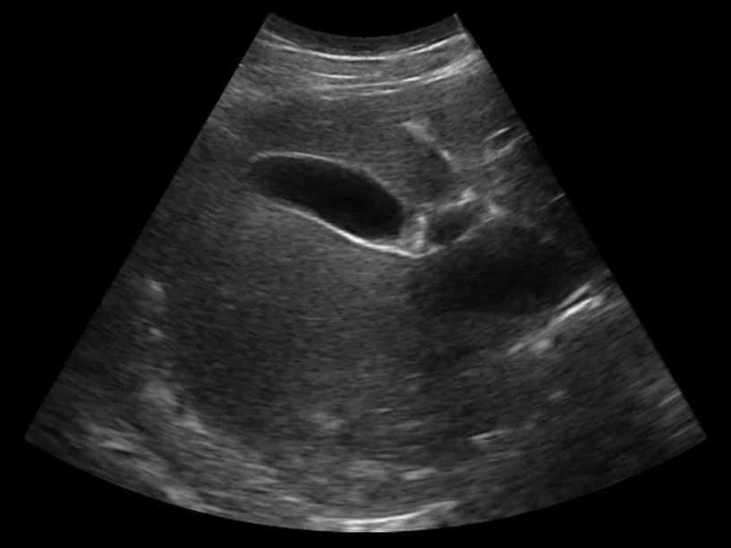 todopocus c5sh convex probe abdominal b-mode at 3.2 mhz and 160 mm depth