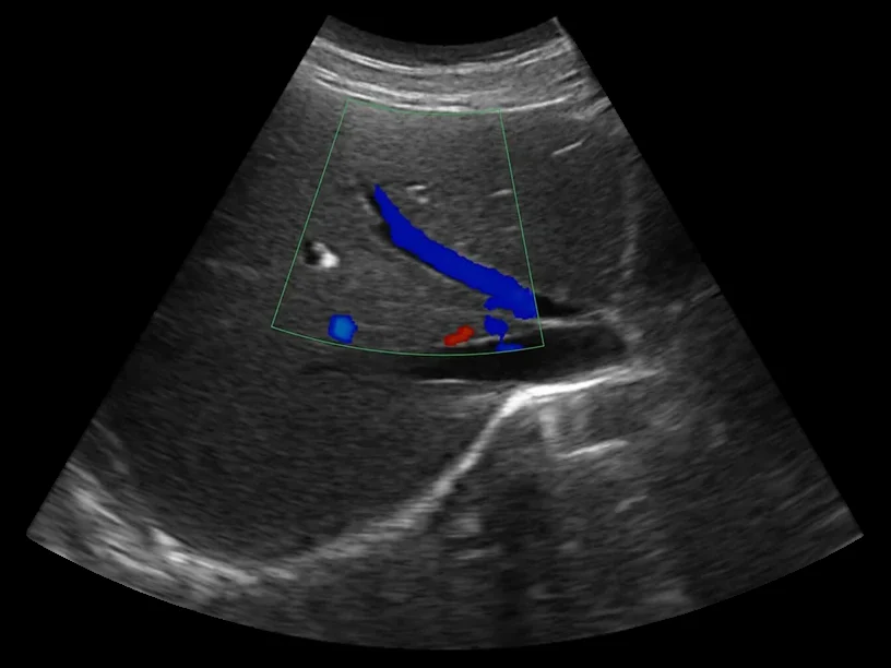 todopocus c5sh convex probe liver color doppler at 3.2 mhz