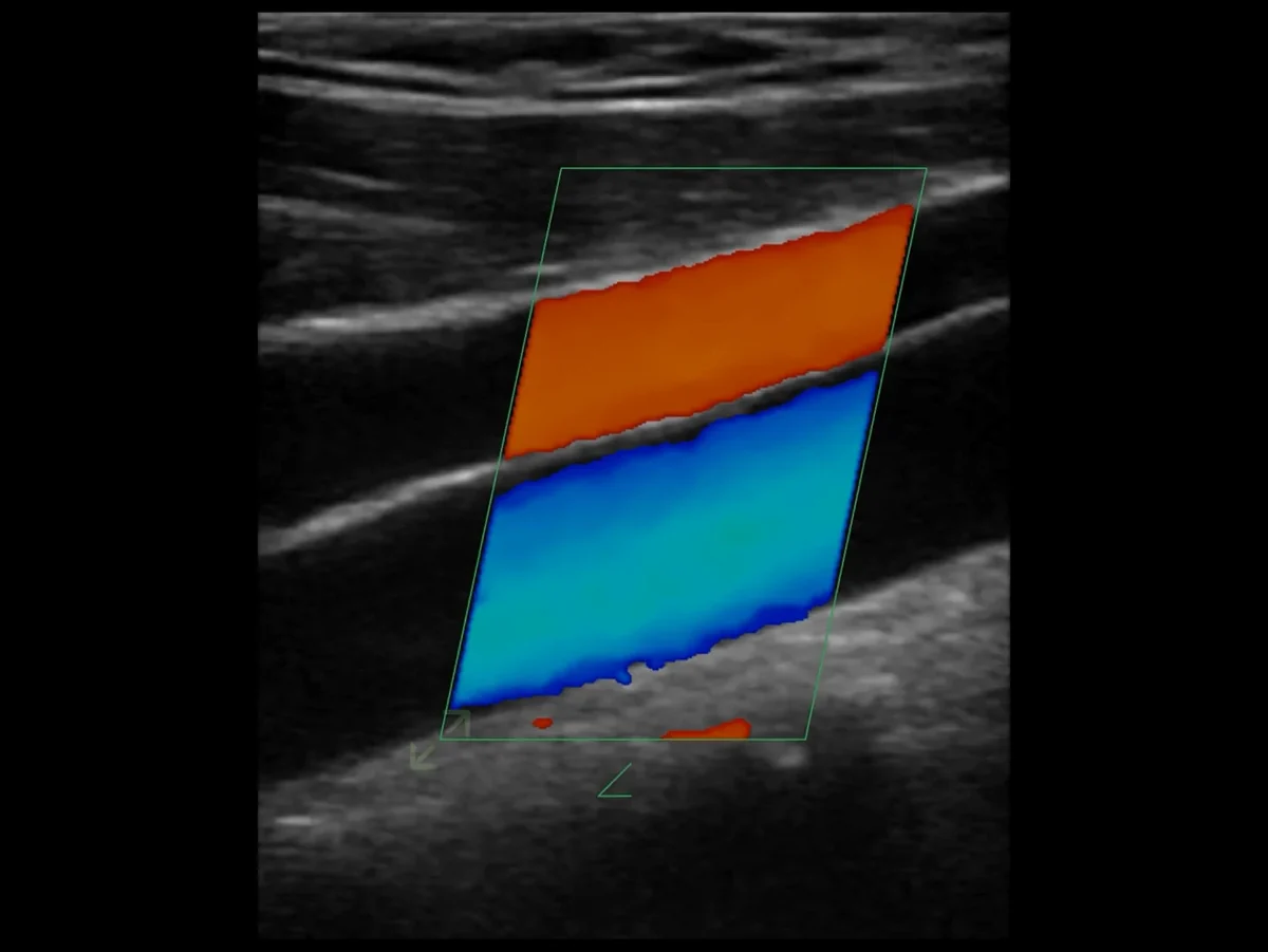 todopocus cd2 linear array carotid color doppler at 10 mhz