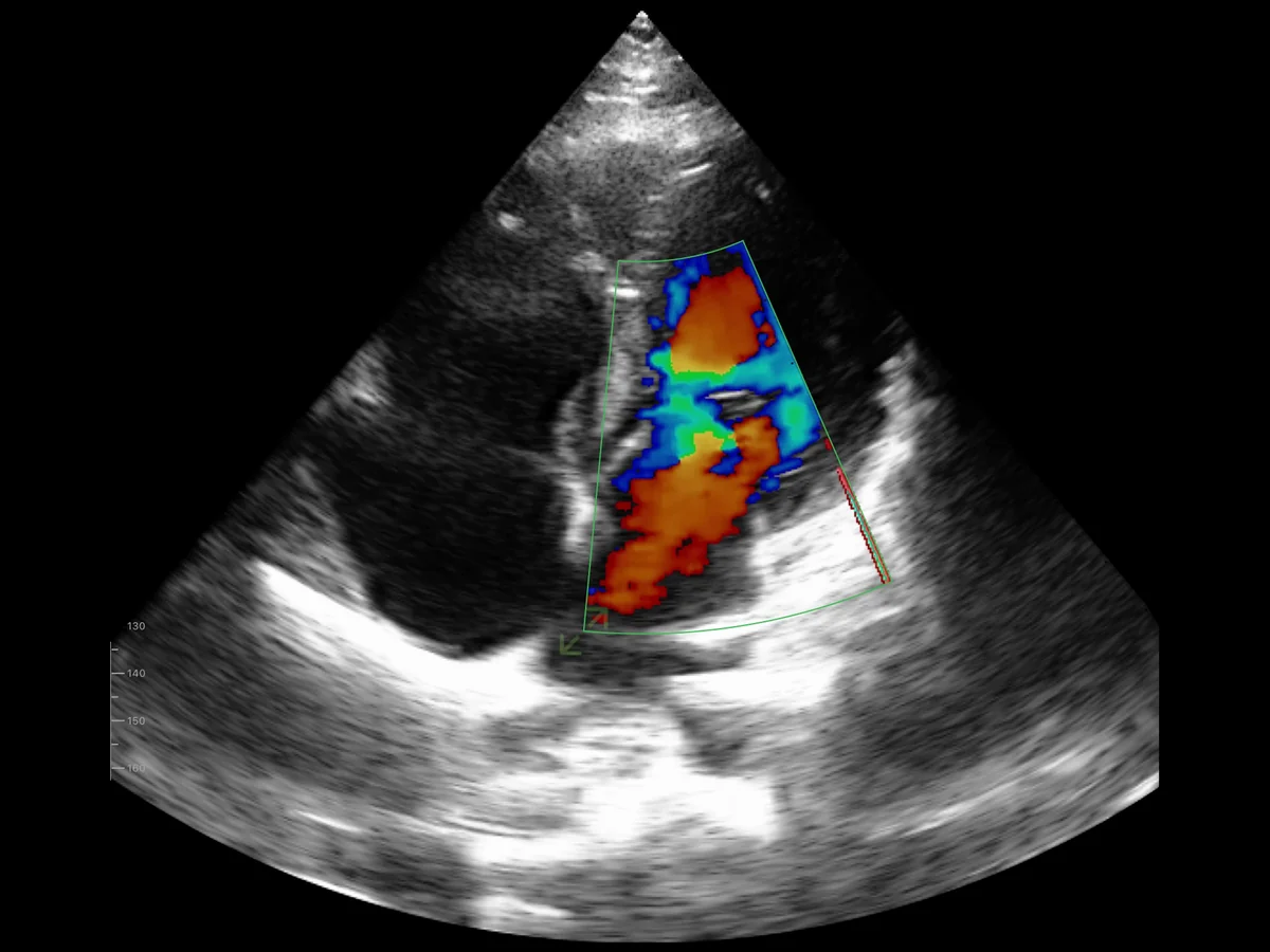 todopocus cd2 phased array cardiac color doppler