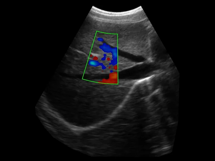 todopocus d2t convex head abdominal color doppler at 3.5 mhz