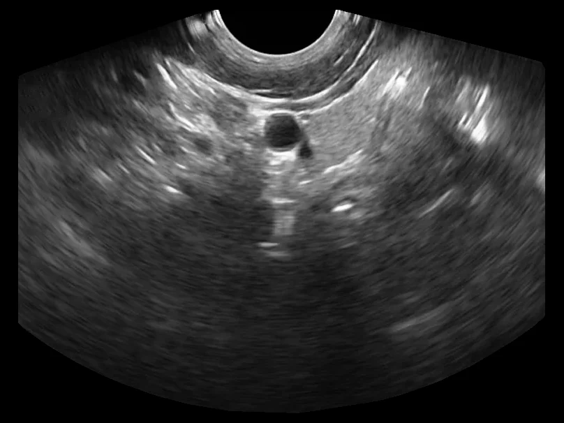 todopocus d2t transvaginal head gynecological b-mode at 8 mhz
