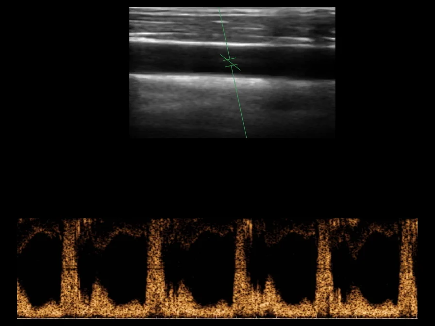 todopocus l10h-guide 10 mhz pw doppler of the carotid artery