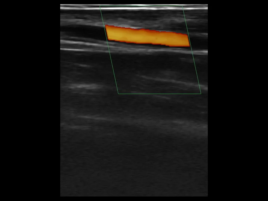 todopocus l10h-guide 10 mhz color doppler of wrist vessels