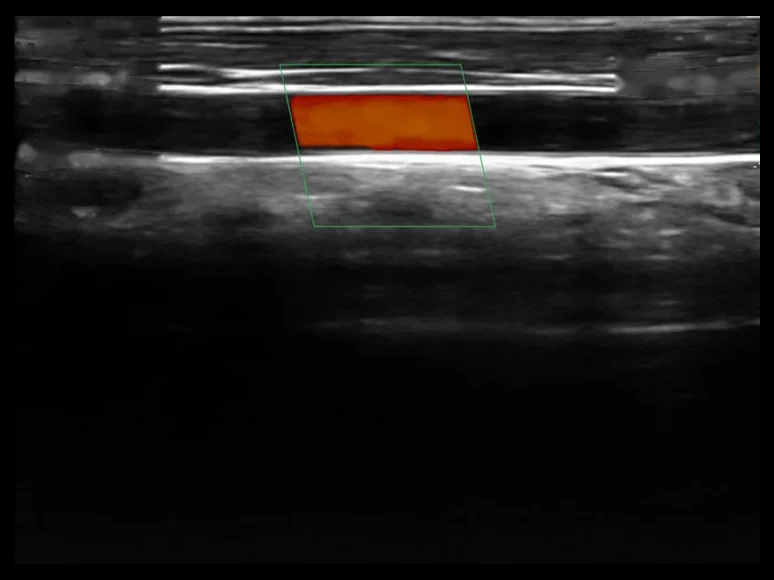 todopocus l10w 80 mm wide linear probe vascular color doppler at 7.5 mhz