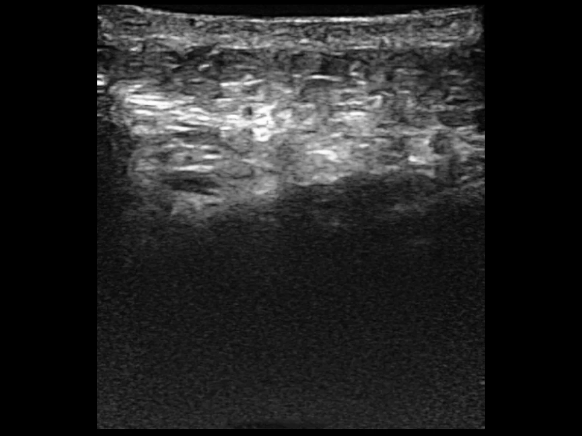 todopocus l14 pro 13.2 mhz longitudinal b-mode of skeletal muscle at 30 mm depth
