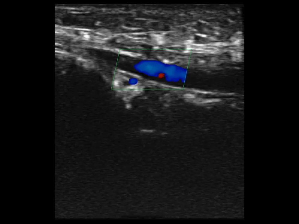 todopocus l14 pro 13.2 mhz color doppler of superficial vessels for vascular access