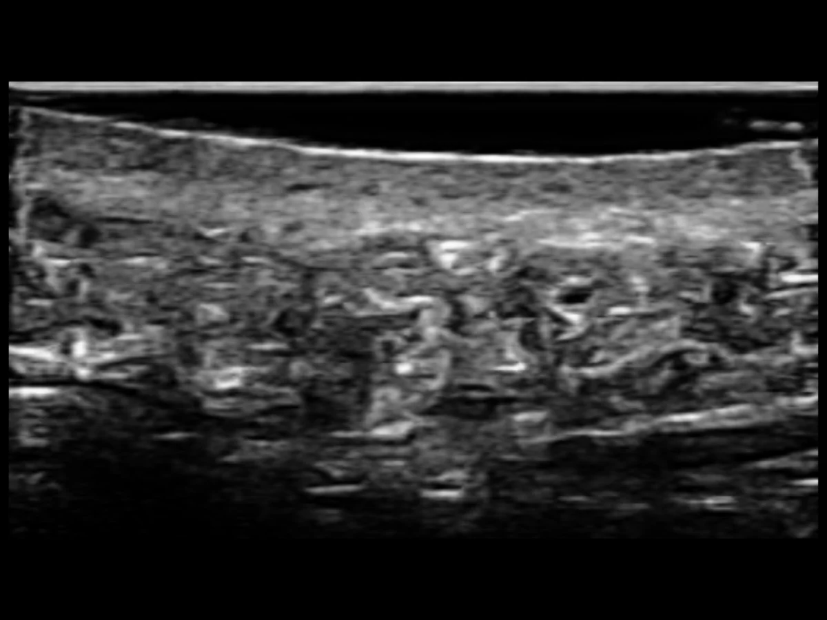 todopocus l20pro 20 mhz b-mode of the epidermis, dermis and subcutaneous tissue