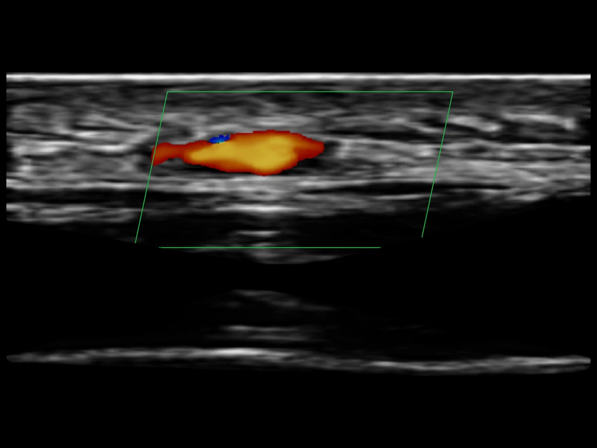 todopocus l20pro 20 mhz color doppler of subcutaneous blood flow