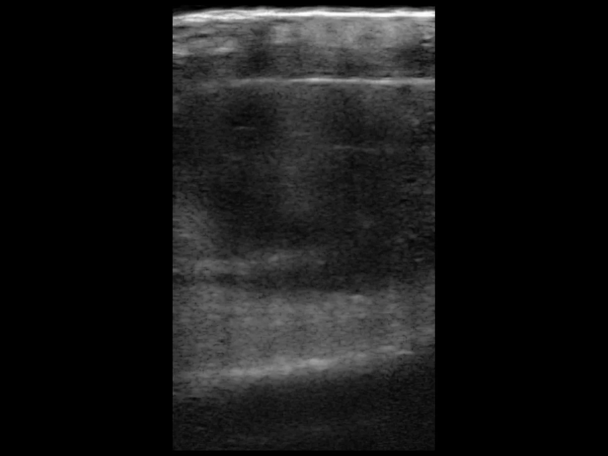 todopocus l24pro 18 mhz ultrasound of a scalp abscess