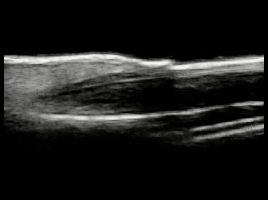 todopocus l24pro 24 mhz ultrasound of the nail matrix and nail bed