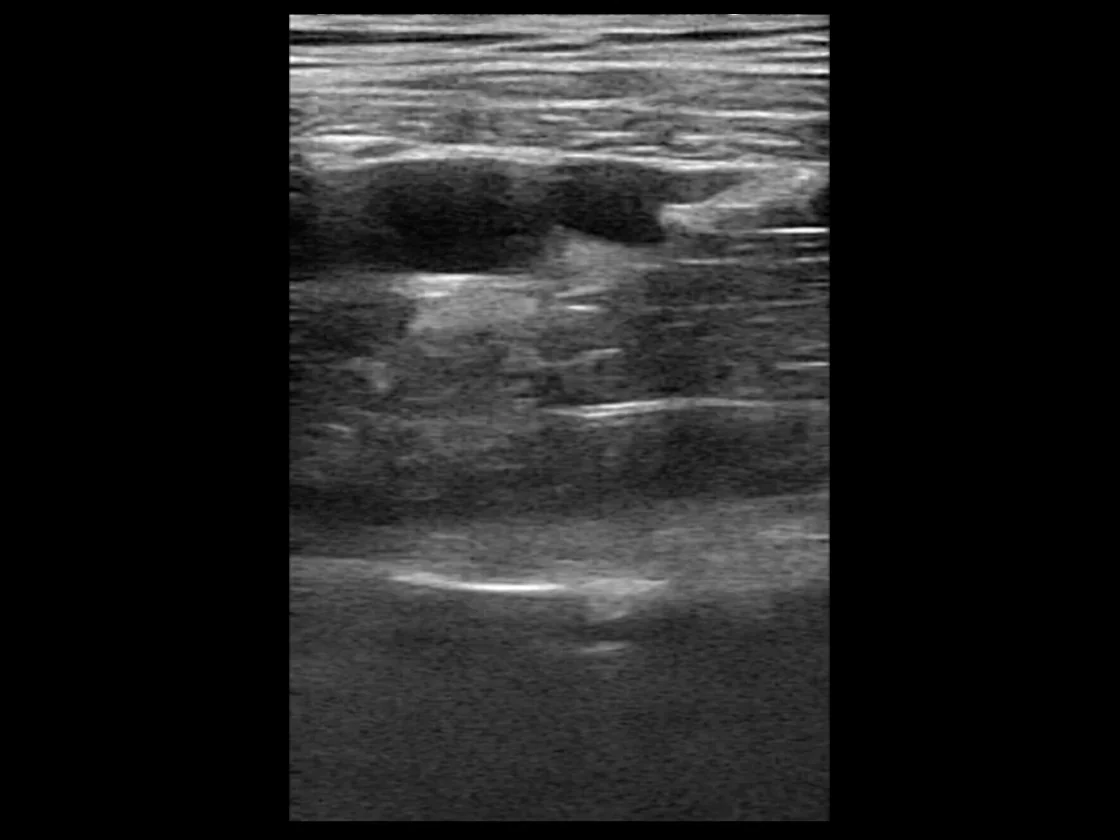 todopocus lc1 biplane intracavity probe linear-plane b-mode image
